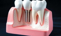 佛山种牙爆料最新消息,价格透明，技术革新，患者口碑爆棚